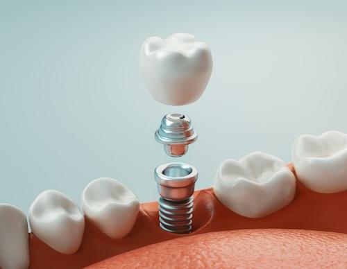 image of a dental implant in coburg north
