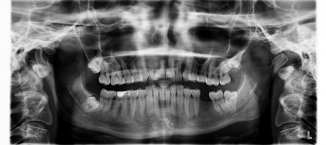 dental x-ray showing a missing tooth